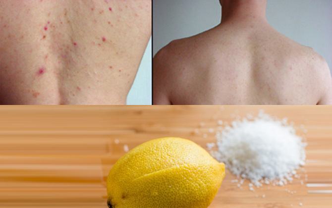 Treat back acne with lemon and salt