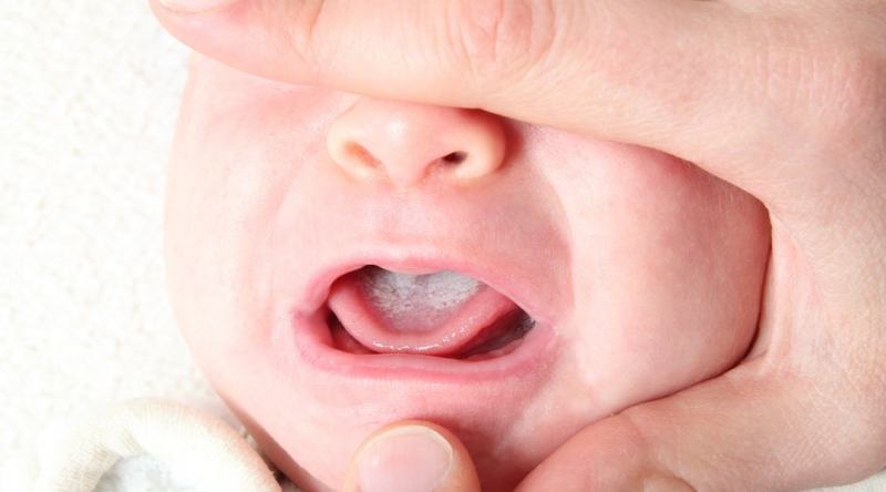 Children are prone to thrush due to sucking on the breast while sleeping