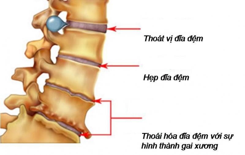 Virus of herniated disc affects bones and joints