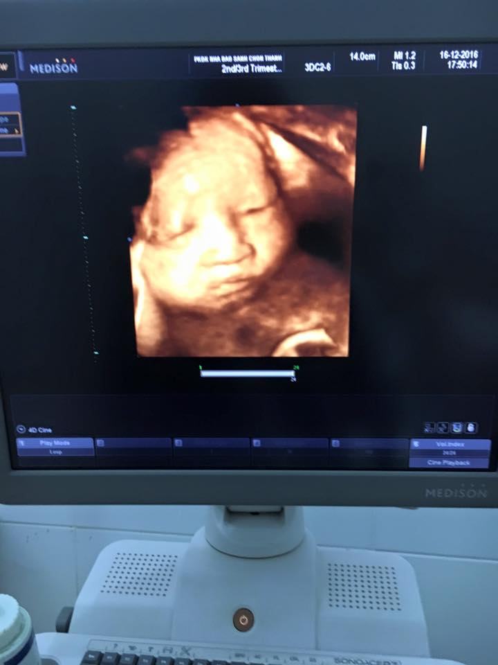 Ultrasound imaging 4D