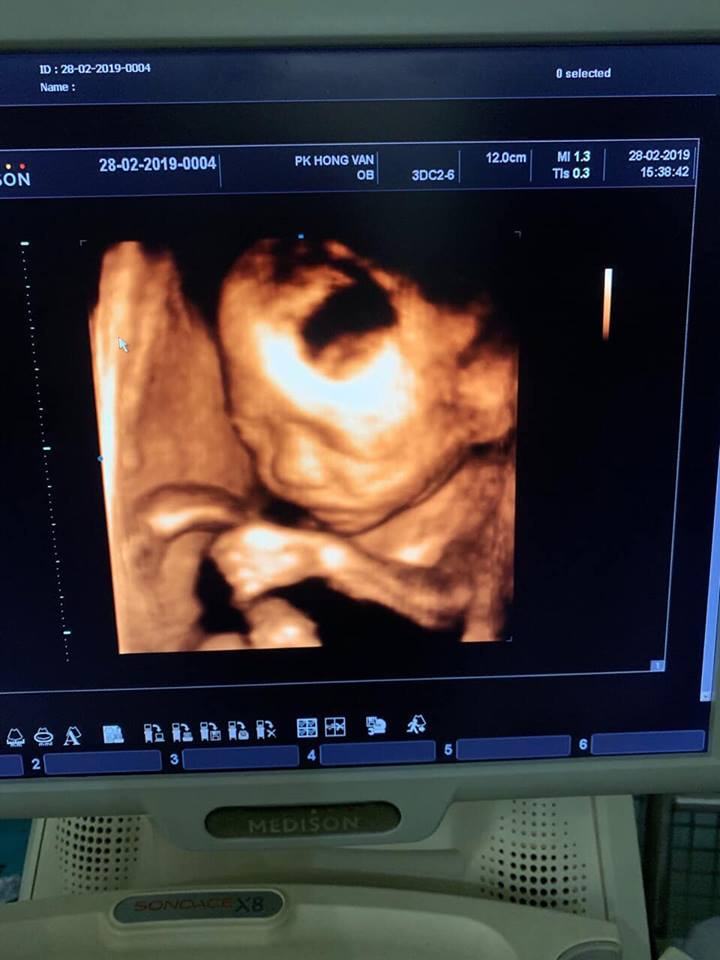 4D pregnancy ultrasound