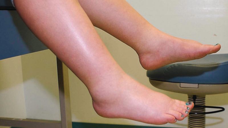 Leg swelling is a sign of kidney failure