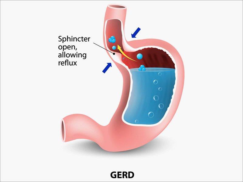 Gastroesophageal reflux disease (Gerd)