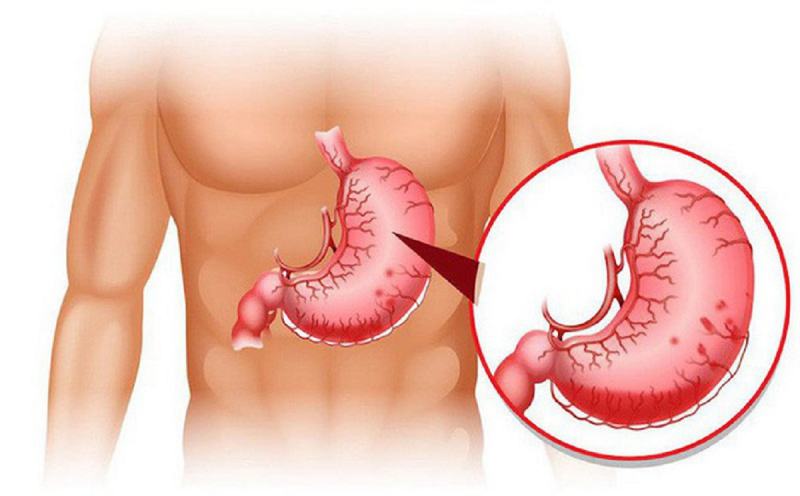 Hypertrophic stomach disease (Ménétrier's disease)