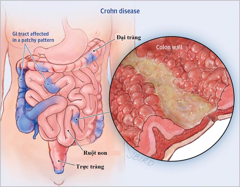 Regional Inflammatory Bowel Disease (Crohn)