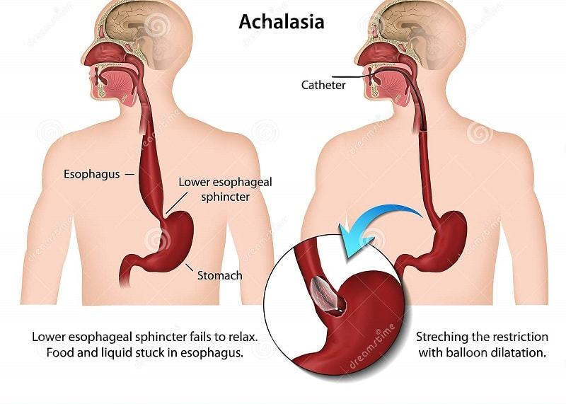 Achalasia (Achalasia)