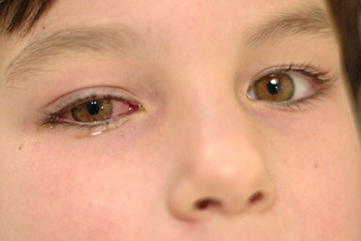 Using many types of eye drops at the same time can cause burning, watery eyes