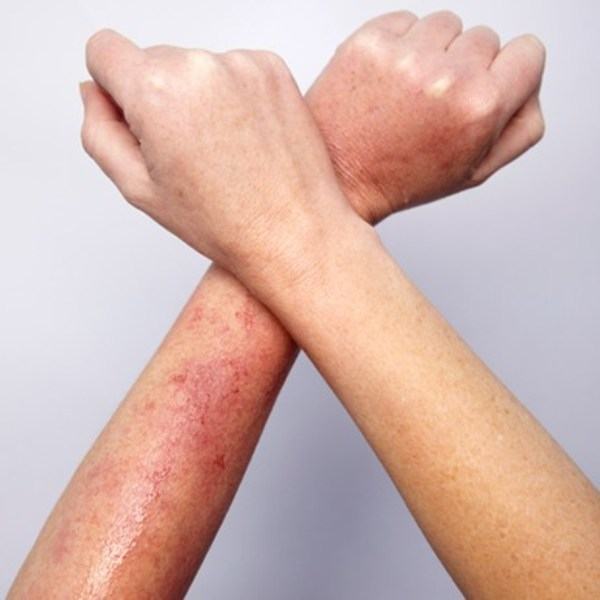 Skin rashes due to seasonal allergies