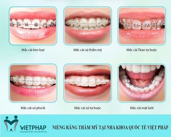 Types of cosmetic braces are being applied in Vietnam France