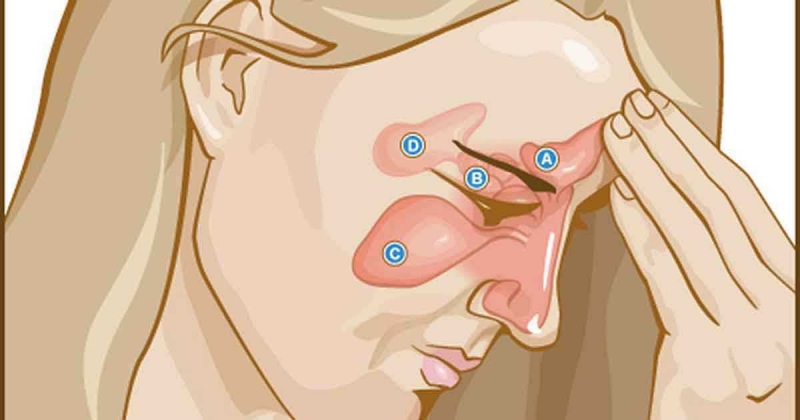 Sinus headaches are common in people with sinus problems