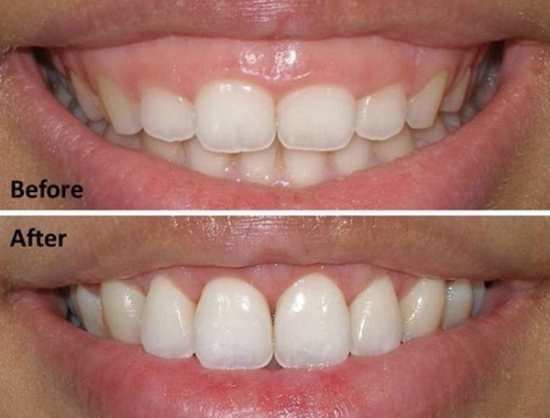 Photos of customers before and after gummy smile treatment at A A U Beauty Hospital