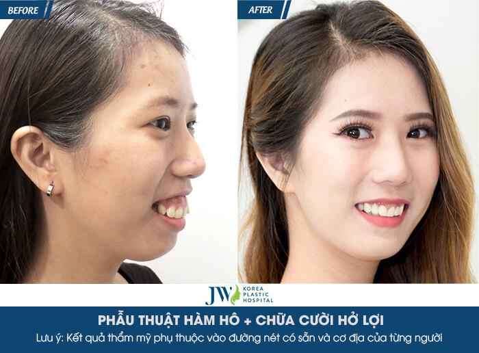 Results of customers with gummy smile treatment at JW