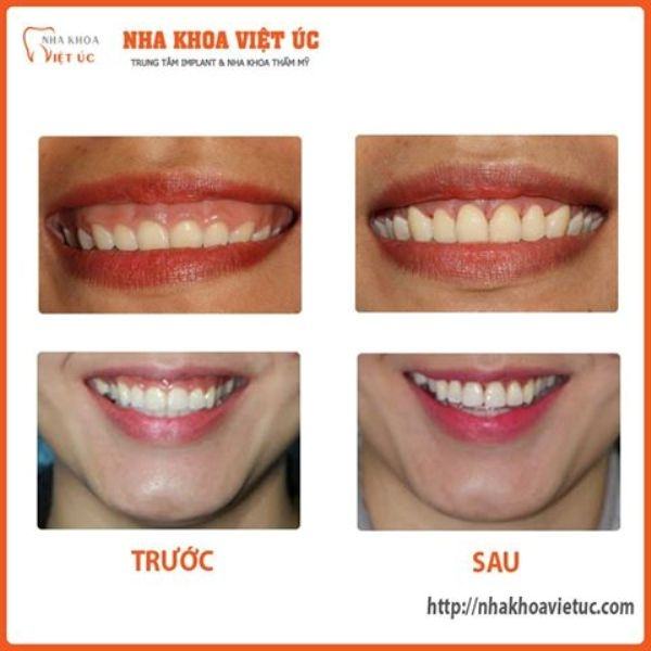 Results after gummy smile treatment at Saigon International's molars