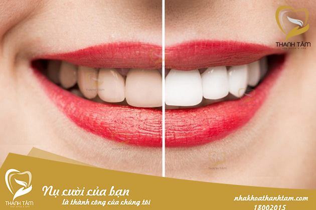 Customers after teeth whitening at Thanh Tam dental clinic