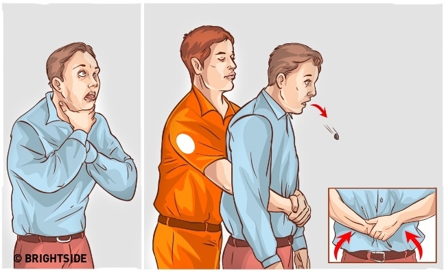 Prevent suffocation with the Heimlich maneuver