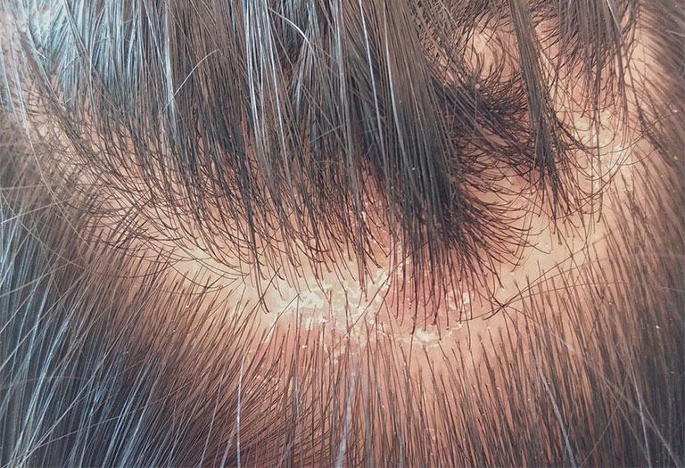 Scalp fungal disease causes hair loss