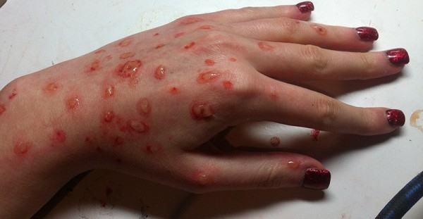 Symptoms of Chickenpox