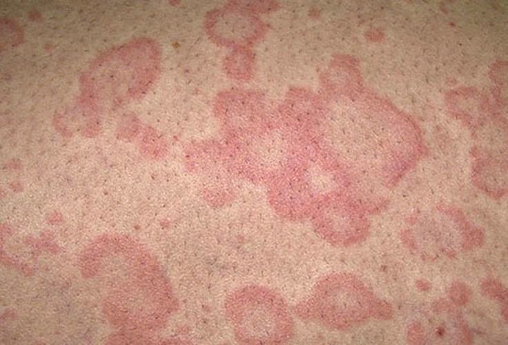 Signs of Measles
