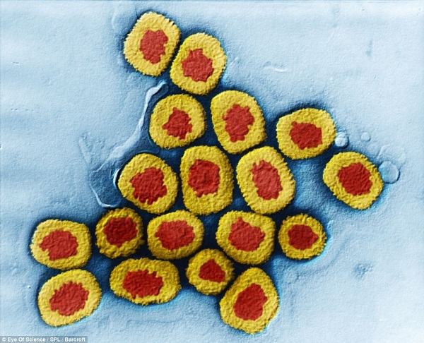 Smallpox - a worldwide epidemic