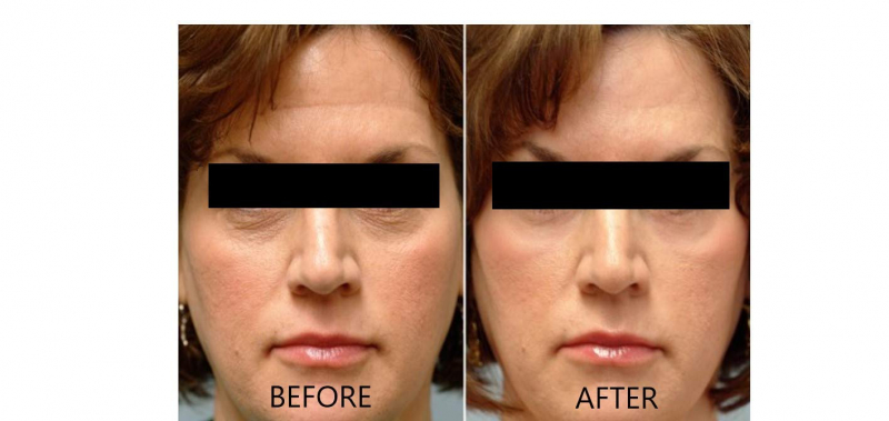 Before and after using SkinCeutical Phloretin CF