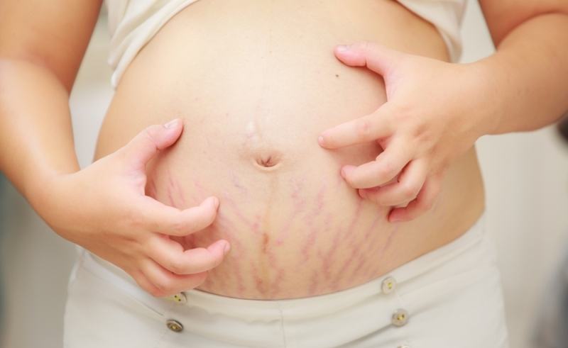 Treatment of stretch marks