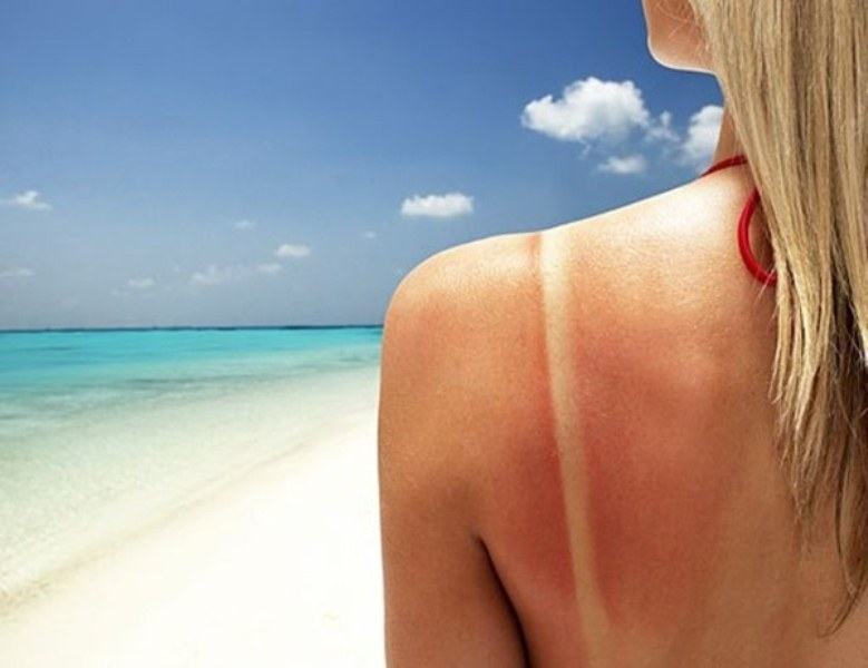 Restore sunburned skin