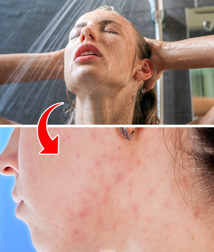 Facial skin has more acne