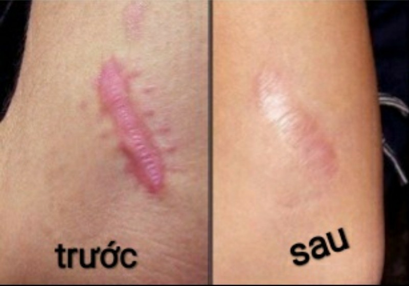 Dermatix scar support cream