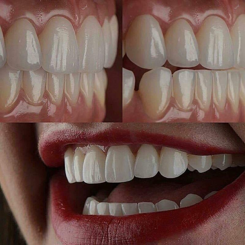 Teeth are more beautiful when coming to Le Gia Dental Clinic