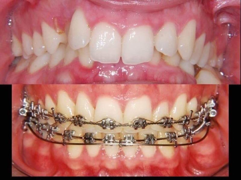 Braces and orthodontics for a better smile