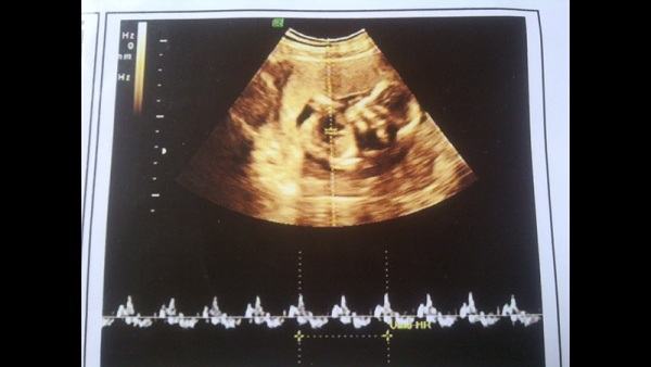 First prenatal visit (6 - 8 weeks)