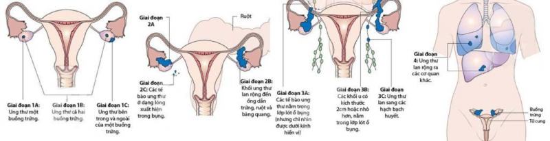 Stages of ovarian cancer development