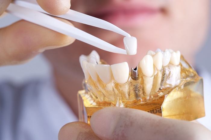 Dental implant service at Viet Phap Dental Clinic
