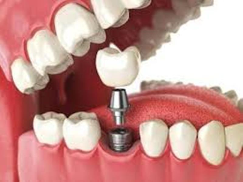 Tokyo Dentistry implements Impland dental implant technique quite successfully