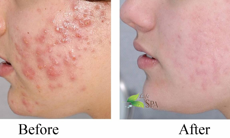Effective acne treatment
