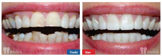 Before and after braces at Paris dental