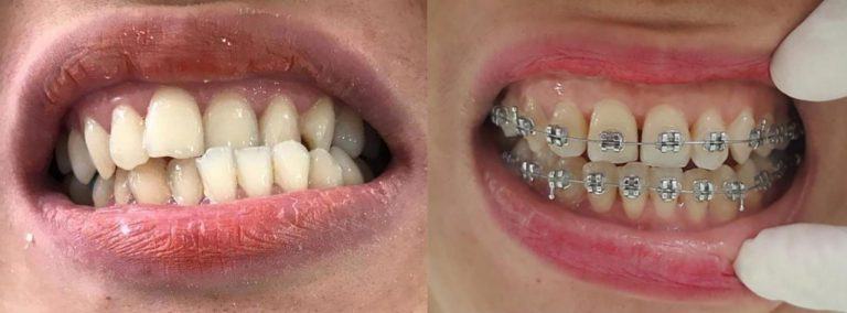 Braces and braces at Viet Khuong Dental Clinic