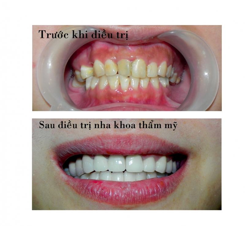 Results before and after cosmetic dental treatment