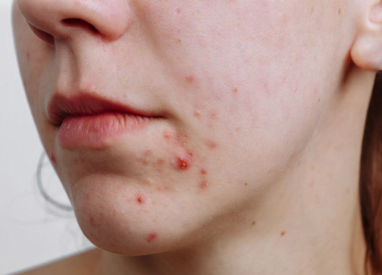 Why does acne appear during puberty?