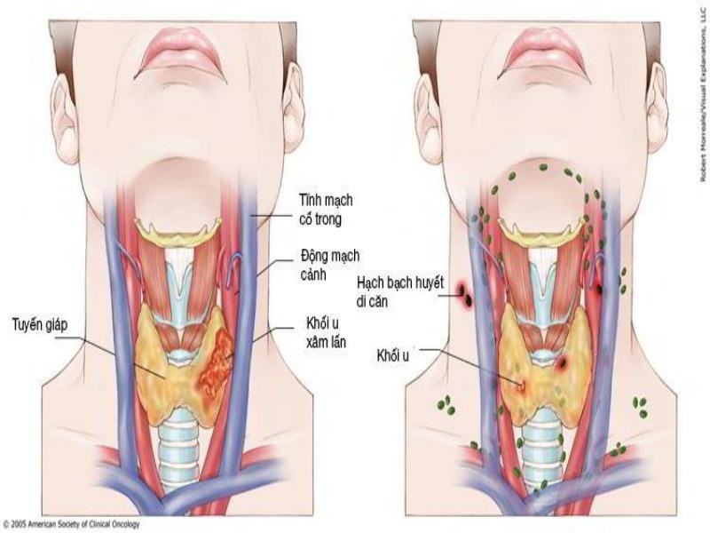 Nasopharyngeal cancer is one of the leading cancers of the head, face and neck
