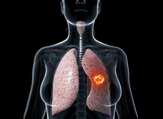 Lung cancer is the most common cancer affecting both men and women