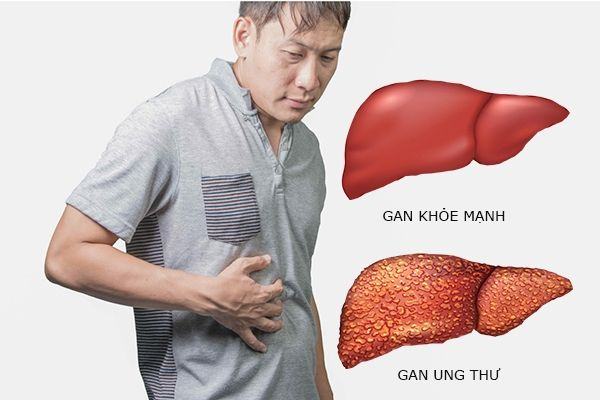 According to Globocan 2018, in Vietnam, liver cancer ranks first in terms of both mortality and number of new cases