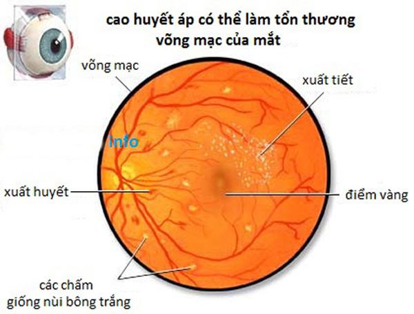 Effects of hypertension on the eyes